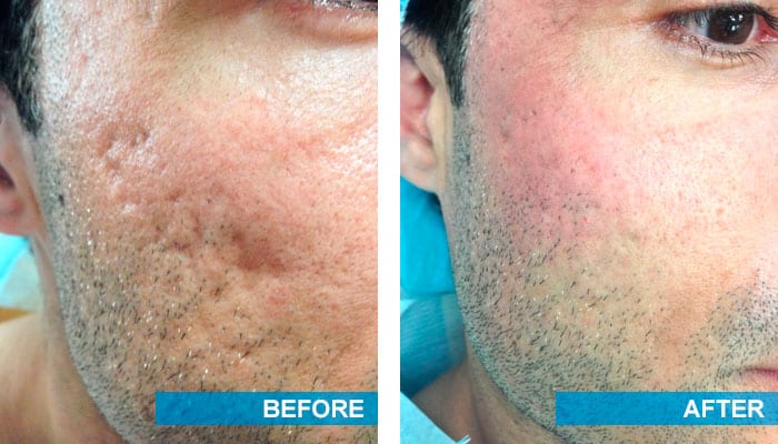 Acne scar treatment before and after