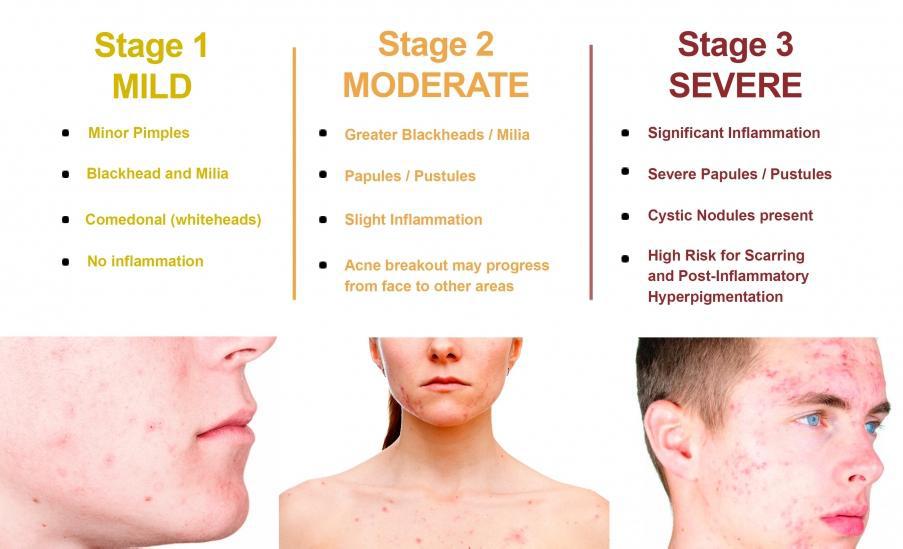 Stages of Acne in the body