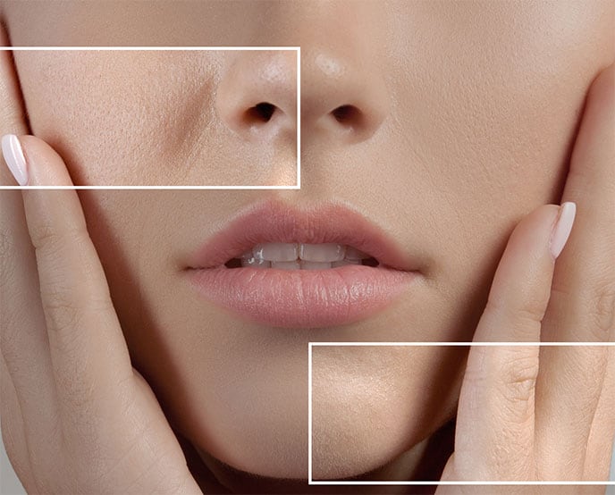 pore refining laser in mississauga