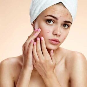 Acne Treatment