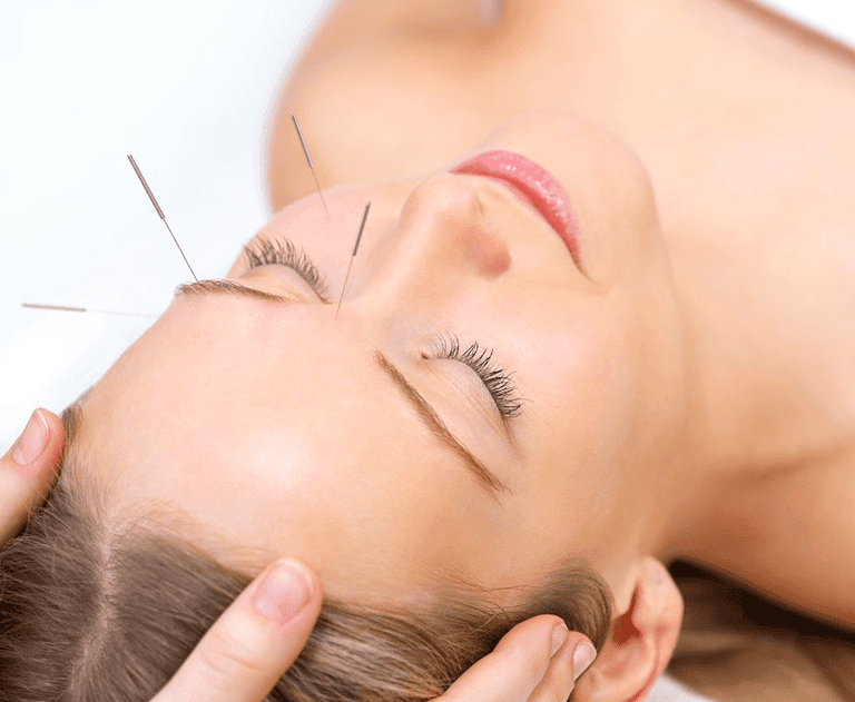 We offer acupuncture facial in Mississauga. Contact us for more details!