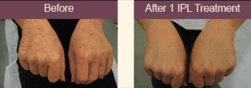 aging hand treatment before and after
