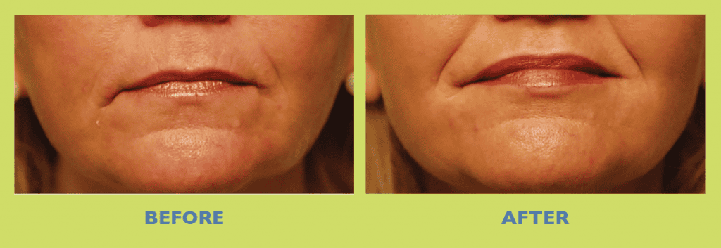 thin lips treatment before and after
