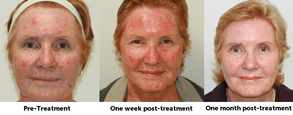 sun damaged skin treatment phases shown