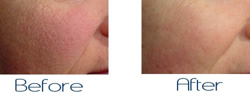 pores treatment before and after