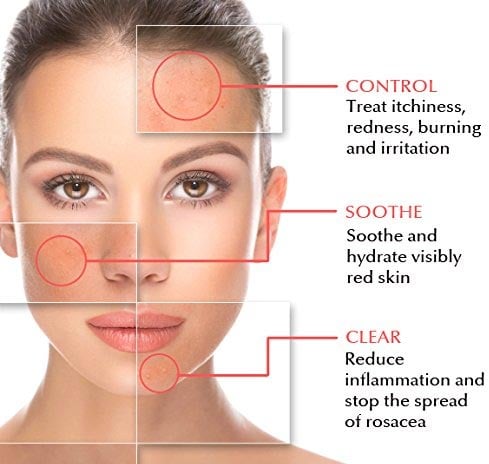 Rosacea natural treatment
