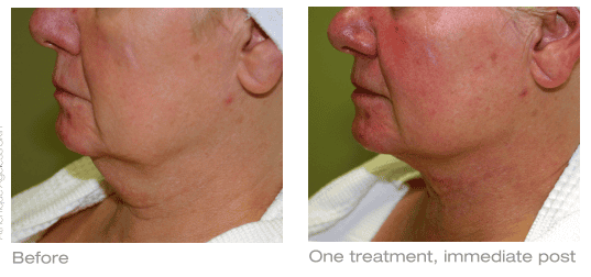 saggy body skin treatment before and after