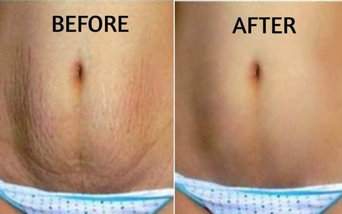 stretch mark treatment before and after pregnancy