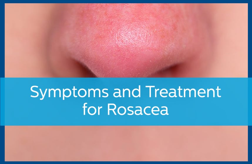 Symptoms and treatment for rosacea
