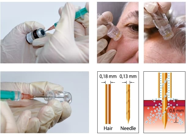 Aquagold Facial treatment Mississauga