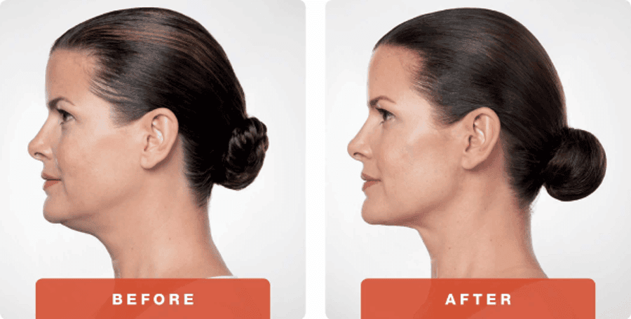 double chin treatment before and after