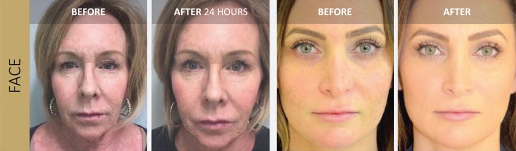 Aquagold Facial treatment Mississauga