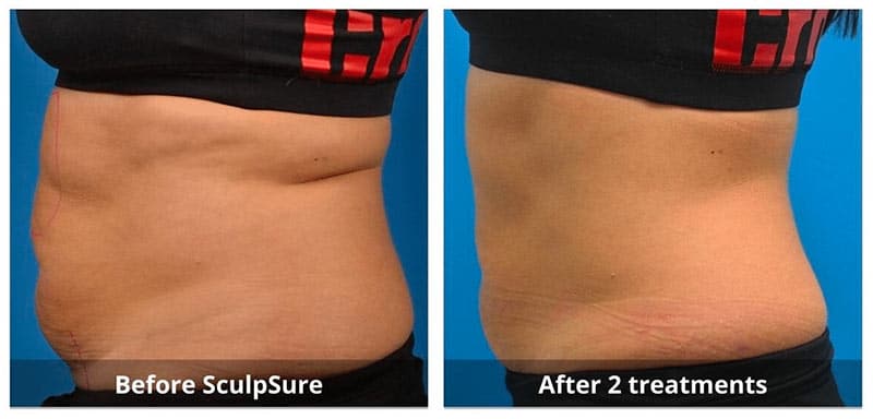 body fat treatment before and after 4