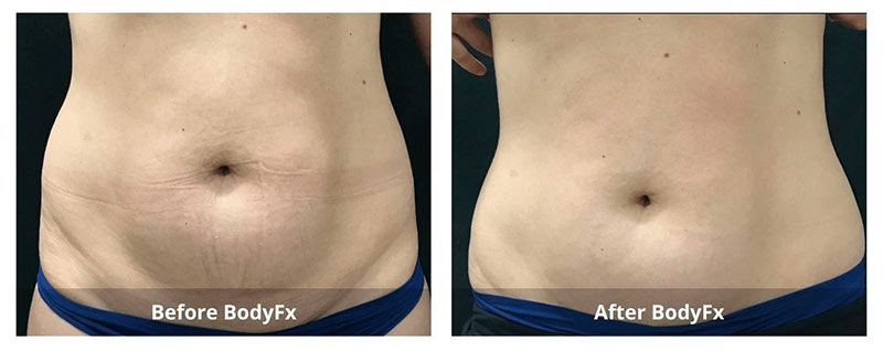 body fat treatment before and after 3