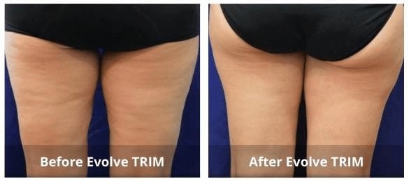 body fat treatment before and after 2