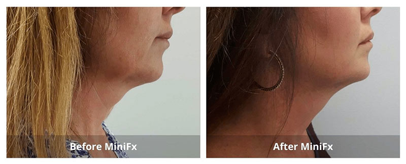 body fat treatment before and after 1
