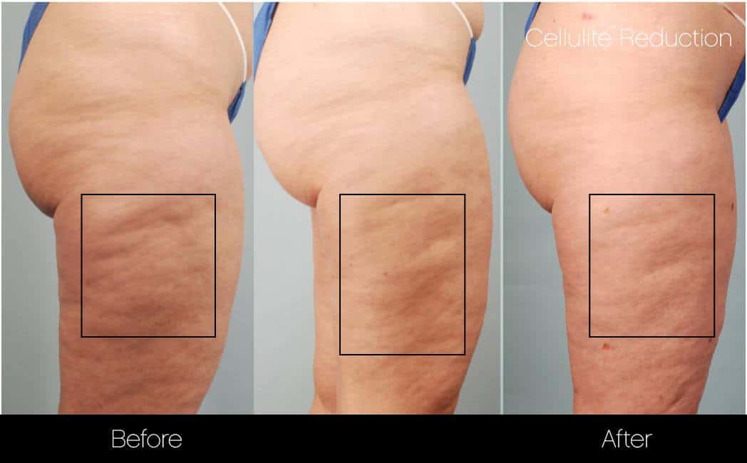 cellulite treatment before and after