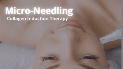 Micro-needling in Mississauga