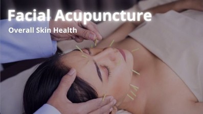 Several ultra-fine acupuncture needles precisely placed along the jawline and forehead for natural lifting at Sunshine Cosmetic Clinic & Medi Spa.