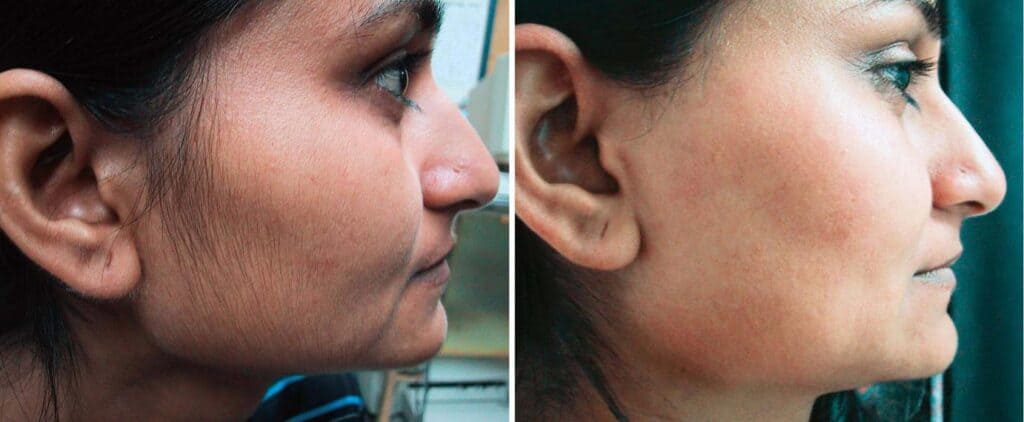 unwanted body hair treatment before and after