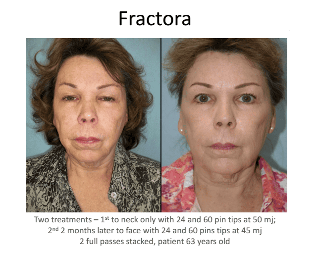 SUNSHINE COSMETIC CLINIC & MEDI SPA Fractora