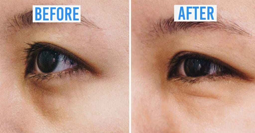 dark eye cycle treatment mississauga