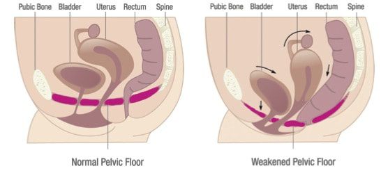 pelvic floor dysfunction
