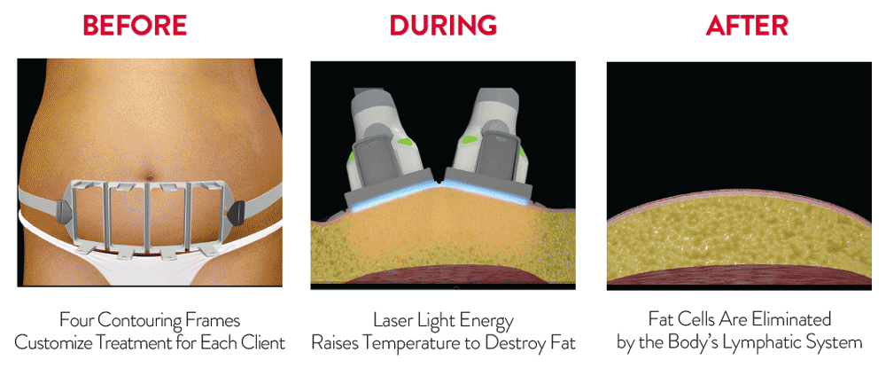 SculpSure® Treatment view ongoing in Mississauga