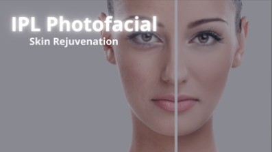 A split-screen comparison showing the removal of sun spots and redness after an IPL Photofacial in Mississauga.