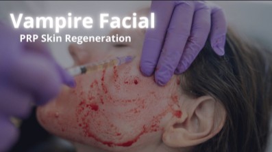 Close-up of the micro-channeling process using platelet-rich plasma for skin regeneration at Sunshine Cosmetic Clinic & Medi Spa.