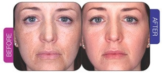 uneven skin tone before and after treatment