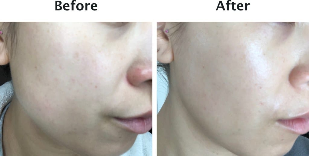 uneven skin tone before and after