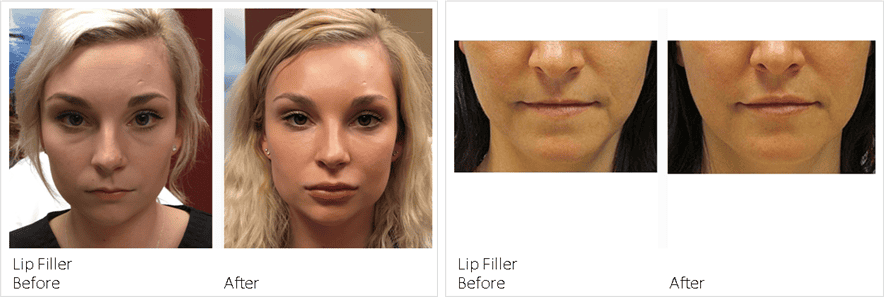 dermal filler before and after