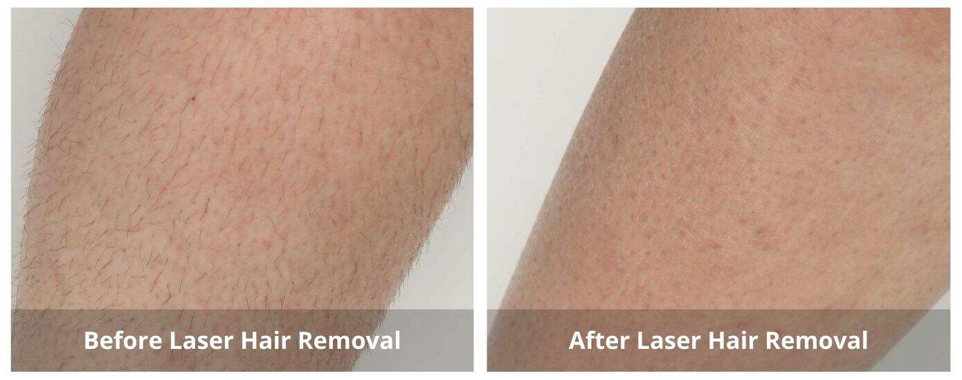We offer laser hair removal mississauga services. Check the laser hair removal before and after pictures!