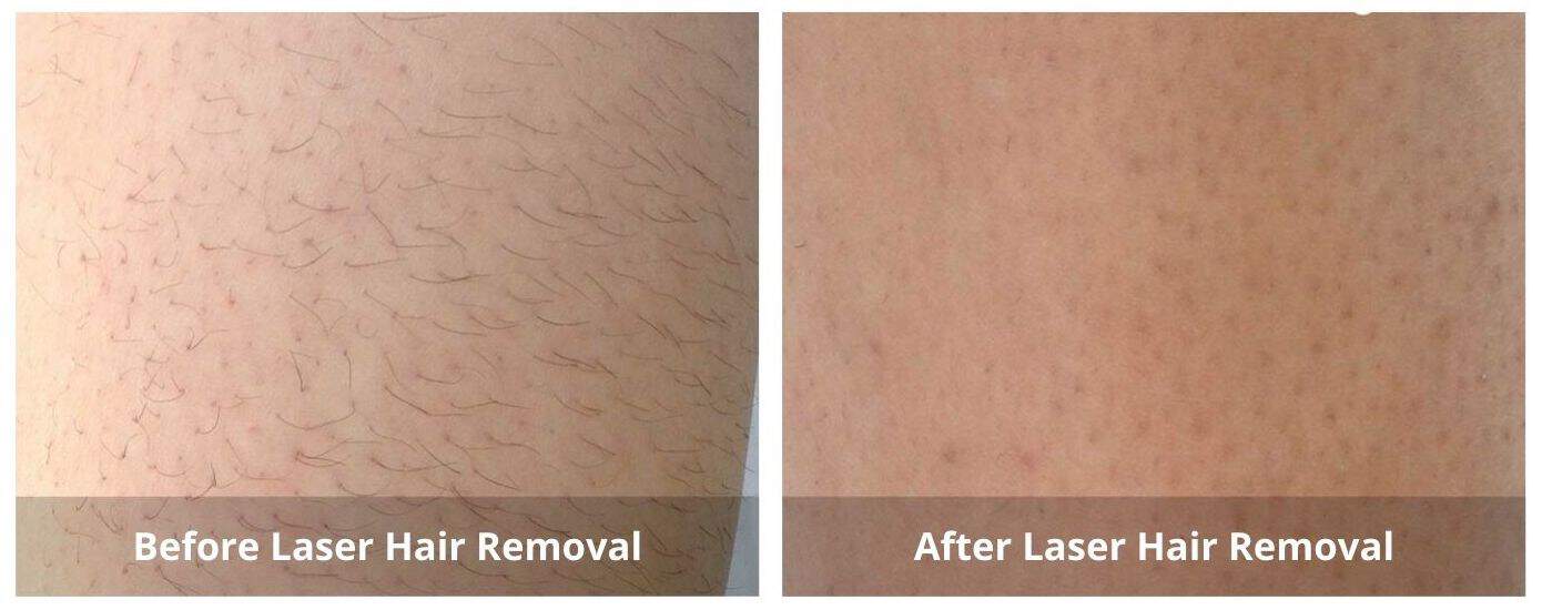 We offer laser hair removal mississauga services. Check the laser hair removal before and after pictures!