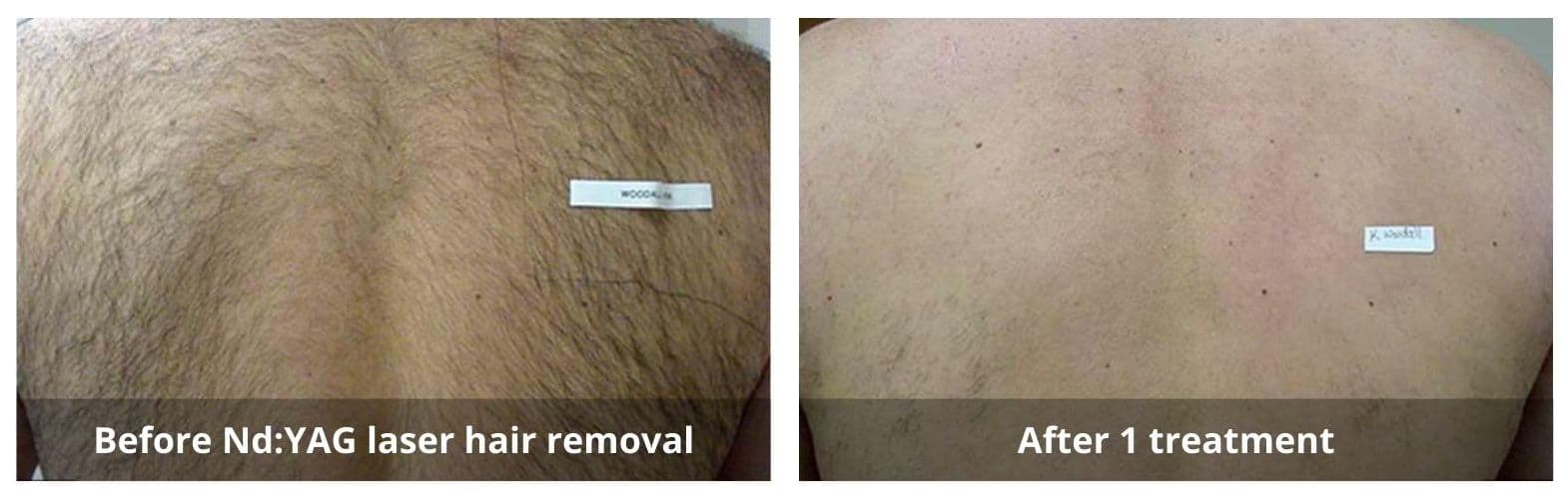 We offer laser hair removal mississauga services. Check the laser hair removal before and after pictures!