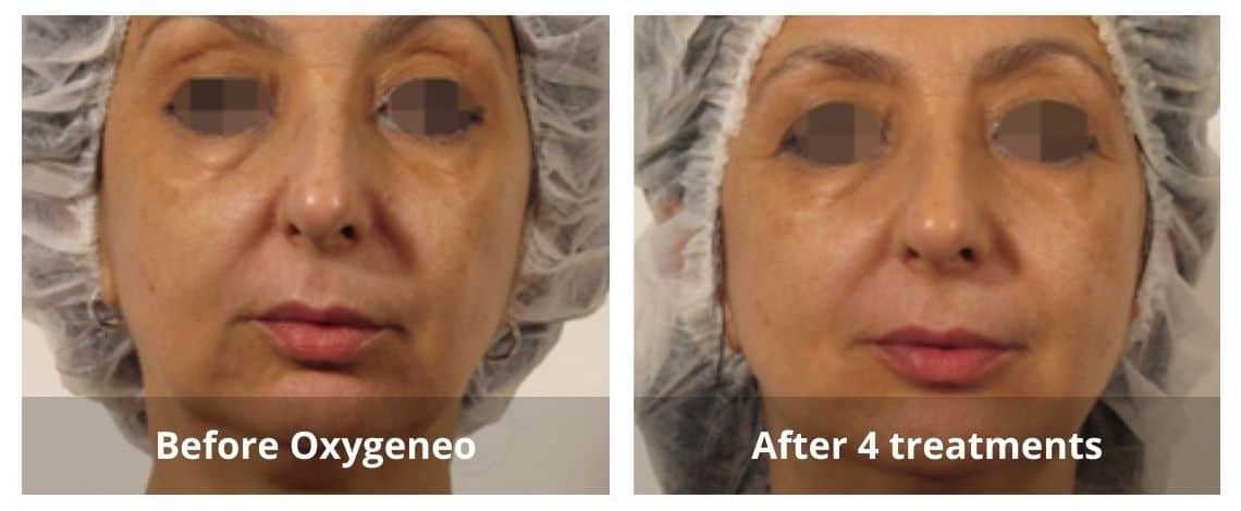 Before and after OxyGeneo treatment in Mississauga
