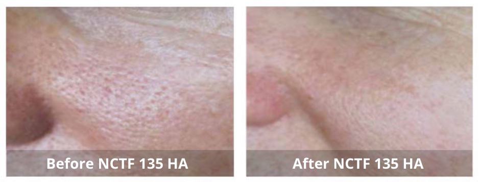 Skin Booster Mississauga treatment in progress