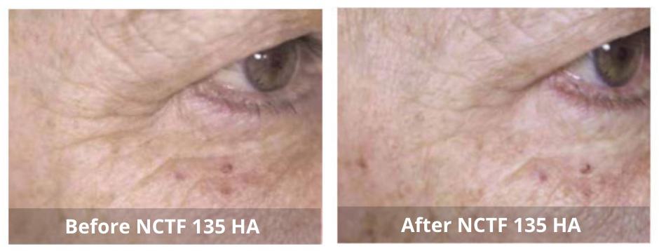 Skin Booster Mississauga treatment in progress
