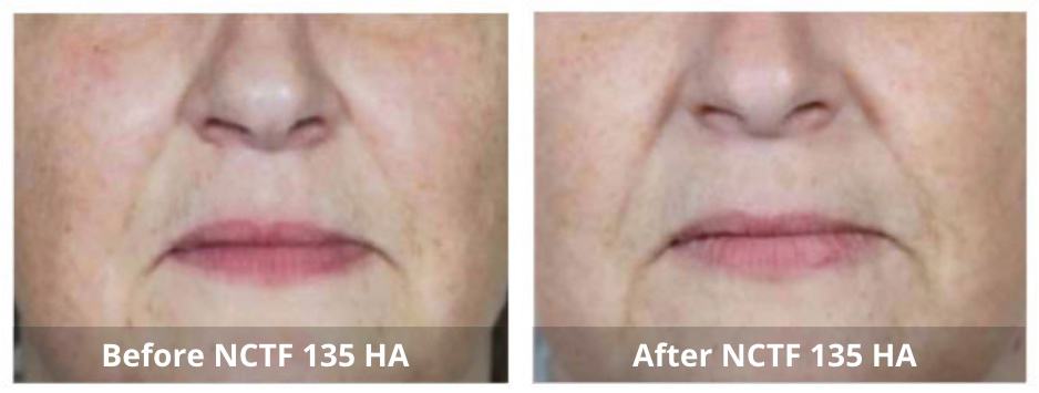 Skin Booster Mississauga treatment in progress