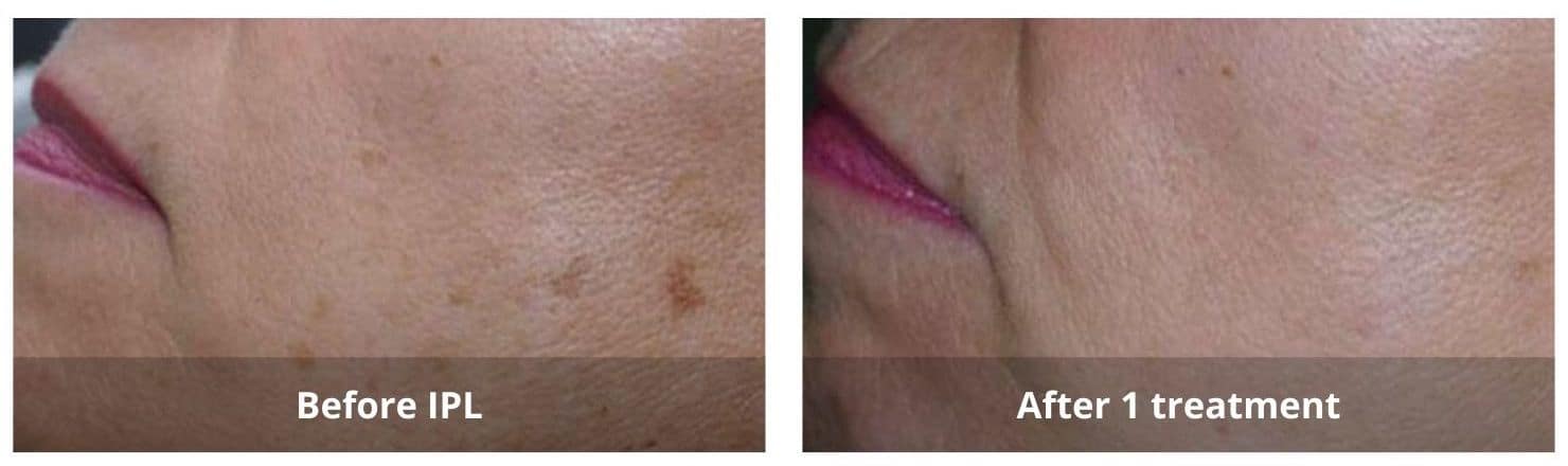IPL Photofacial Mississauga treatment in progress