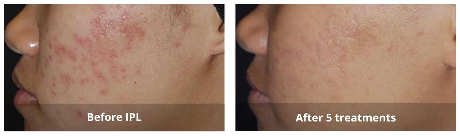 IPL Photofacial Mississauga treatment in progress