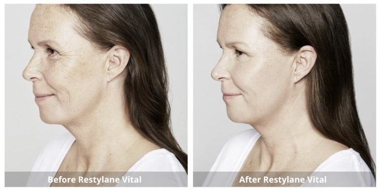 Skin Booster Mississauga treatment in progress