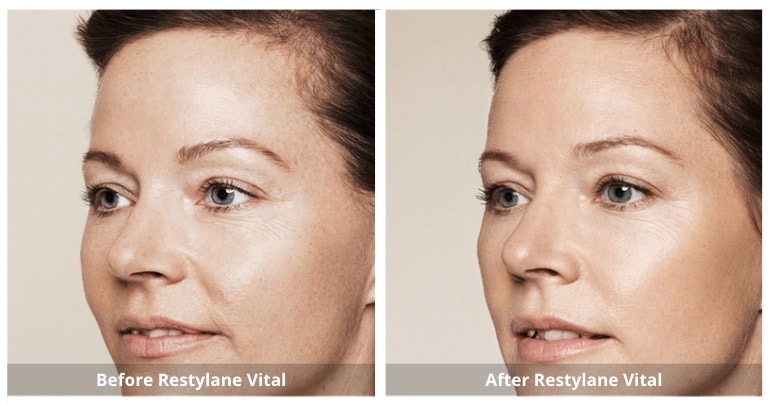 Skin Booster Mississauga treatment in progress