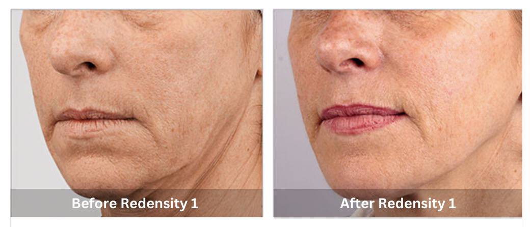 Skin Booster Mississauga treatment in progress