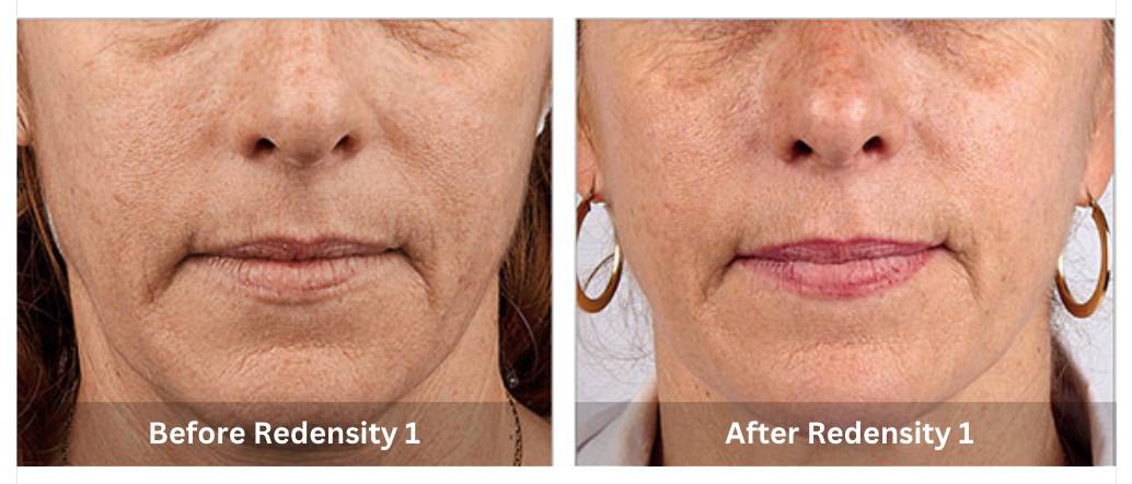 Skin Booster Mississauga treatment in progress