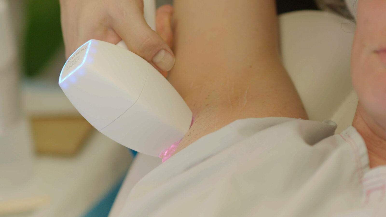 DioLazeXL-treatment in progress