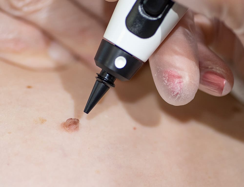 CryoProbe Mississauga treatment in progress