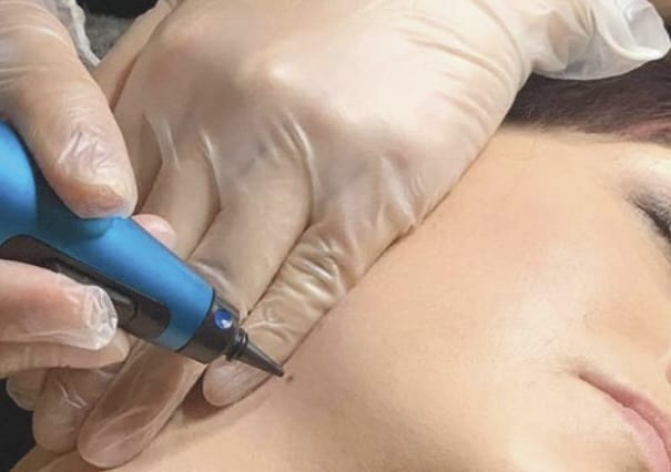 Cryotherapy is used to treat all sorts of skin disorders at our practice in Mississauga.