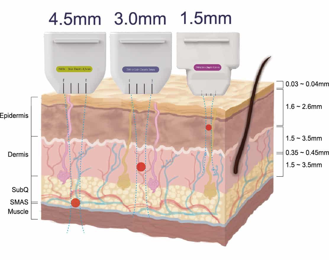 Ultherapy is the only FDA approved non-surgical procedure for SMAS lifting. We are the only Ultherapy authorized provider in the city of Mississauga as of this written. Contact us today for your skin tightening or facelift needs.